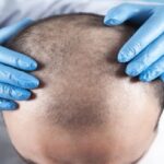 Hair Transplant in India: The Latest Techniques and Technologies