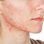 How do you get rid of nodules from acne?