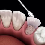 What Is Bone Grafting for Dental Implants, and How Is It Done?