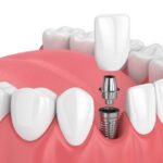 How Missing Teeth Can Influence Dental Health and Appearance?