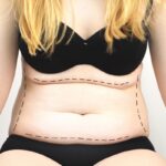 How Long Later Can You Have a Tummy Tuck After a Bariatric Surgery?