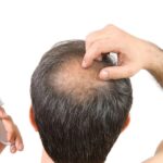 Thicker, Fuller Mane: Natural and Safe Remedies for Male Pattern Hair Loss