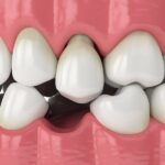 The Benefits of Dental Implants Over Traditional Bridges